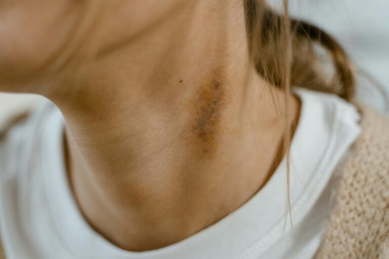 Scar Treatment